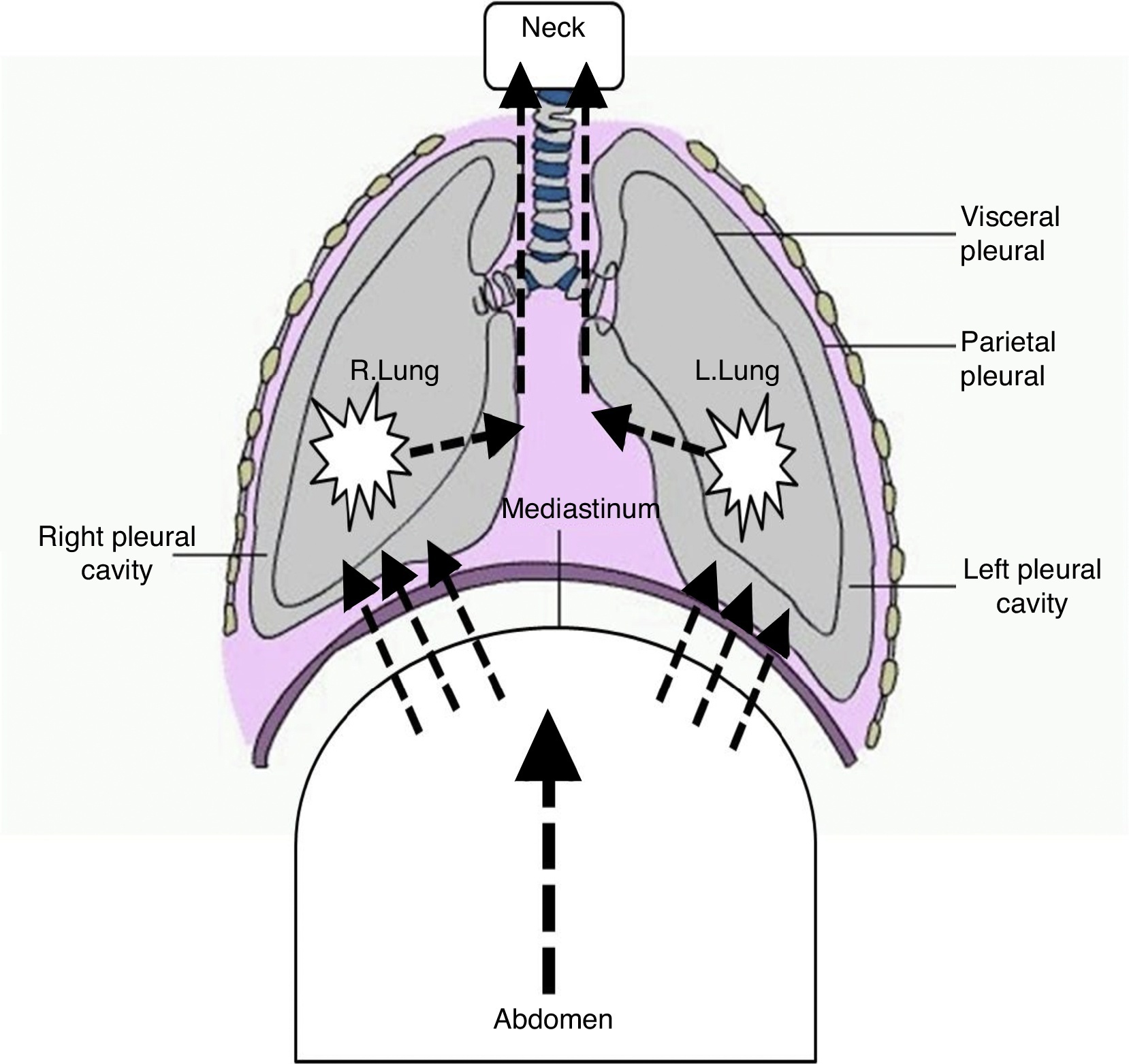 Spontaneous pneumomediastinum in pregnancy A case report Pulmonology