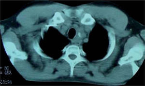 Tomografía axial computarizada de la tumoración paratraqueal izquierda.