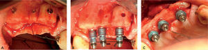La aposición de injertos óseos en bloque en la atrofia del edentulismo maxilar para aumentar la anchura del reborde crestal se puede realizar colocándolos por vestíbulo, palatino o de forma interposicional. La sínfisis mandibular permite obtener injertos mono o bicorticales. A. Injerto mentón. B. Injerto mentón implantes. C. Injerto mentón implantes.