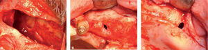 La perforación de la membrana de Schneider es la complicación quirúrgica más frecuente, especialmente cuando existen adhesiones entre la membrana y la mucosa oral, tabiques antrales, improntas óseas de raíces dentales o exodoncias recientes. A. Perforación MB. B. Perforación MB exodoncia reciente. C. Perforación MB adherencia con mucosa oral.
