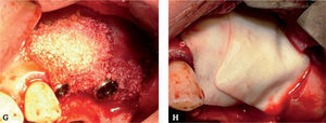 A. Perforación de la membrana no reparable; debemos suspender el injerto óseo sinusal. B y C. Para facilitar la reentrada, se debe colocar una membrana de barrera sobre la ventana lateral, con el fin de prevenir la adhesión de la membrana sinusal al periostio del colgajo vestibular. D y E. Durante la reentrada es necesario ampliar la antrostomía para conseguir salvar la fibrosis formada y conseguir diseccionar la membrana sinusal normal. F-H. Colocación de los implantes e injerto sinusal.