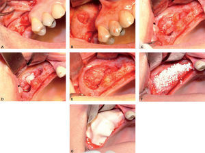 Reentrada tras fracaso por sinusitis maxilar.
