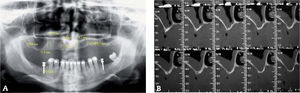 A y B. La tomografía computarizada es capaz de diagnósticar multitud de patologías sinusales no evidentes en la ortopantomografía.