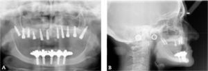 Los implantes pterigoideos constituyen también un complemento del injerto óseo sinusal al proporcionar un buen apoyo posterior