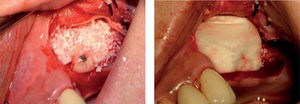 La antrostomía mediante la osteoplastia de la pared lateral permite utilizarla como material de injerto, aunque incrementa el riesgo de lesión de la membrana. A. Osteoplastia marcada sobre la pared lateral del seno. B. Osteoplastia realizada. C. Hueso fijado como injerto de aposición. D. Relleno sinusal del reborde alveolar con xenoinjerto. E. Cobertura con una membrana de colágeno.