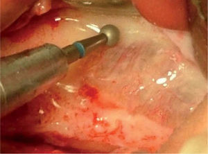 Las fresas de diamante preservan más eficazmente la lesión de la membrana al final de la osteotomía.