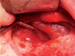 La disección debe realizarse mediante despegadores romos angulados, liberando completamente la membrana de todas sus paredes hasta conseguir la dimensión vertical de los implantes que vamos a colocar.