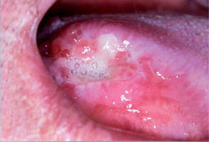 Foto aportada por la paciente de la lesión lingual primaria en el borde lateral derecho.