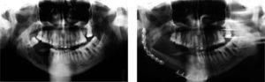 Radiolucencias pobremente demarcadas, con coalescencia entre ellas, correspondientes a la zona de necrosis del hueso mandibular derecho en respuesta al daño vascular.