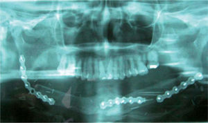 Imagen radiográfica final tras la retirada de la placa causante de la fístula.