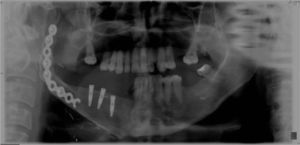 Ortopantomografía. Tres implantes osteointegrados en el área distraída