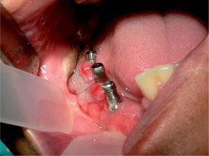 Aspecto clínico intraoral del paciente una vez colocados los implantes. Altura alveolar adecuada.