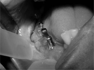 Ortopantomografía. Prótesis implantosoportada sobre implantes osteointegrados en el área distraída.