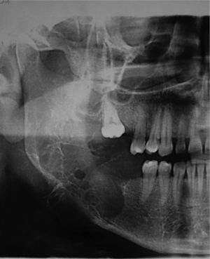 Ortopantomografía: gran lesión radiolúcida que destruye la lámina basal y cortical mandibular.