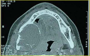 Tomografía computarizada: masa en hemimandíbula derecha que destruye ambas corticales óseas.