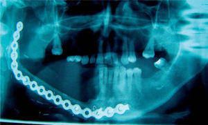 Ortopantomografía tras la reconstrucción mandibular con injerto microvascularizado de peroné. Obsérvese la discrepancia de altura entre el injerto de peroné y la hemimandíbula contralateral dentada.