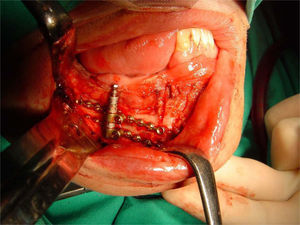Distractor alveolar intraoral colocado y fijado al peroné mediante tornillos, una vez realizadas las osteotomías.