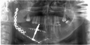 Al final del periodo de consolidación (tres meses). La ortopantomografía confirma una excelente osificación entre la basilar y el fragmento distraído.