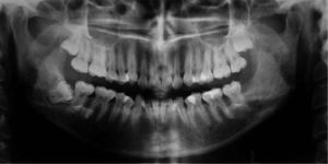 - Control a los 10 meses postexodoncia del tercer molar y enucleación de la lesión más curetaje óseo.