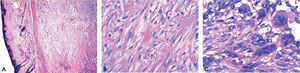 A) En la imagen se aprecia a bajo aumento aplanamiento de la epidermis y subyacente neoplasia bien delimitada, nodular con células fusiformes que forman haces de aspecto arremolinado (tinción HE, ×40). B) Imagen de células fusiformes de hábito fibroblástico con patrón de crecimiento arremolinado y haces de colágeno queloidal, fibras esquenoides (tinción HE, ×400). C) Imagen de células fusiformes de hábito fibroblástico y células gigantes multinucleadas de hábito osteoclástico (tinción HE, ×630).