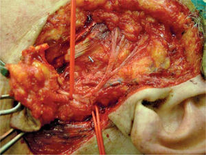 - Rama marginal del nervio facial englobada en el tumor.