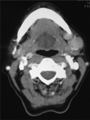 Tomografía computarizada. Presencia de lesiones nodulares, la mayor de 24 mm, que comprimen la región posterior de la glándula submaxilar izquierda y captan homogéneamente contraste, compatibles con adenopatías reactivas.