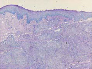 Espécimen histológico que muestra la presencia de epitelio pavimentoso normal de la lengua y, en el estroma subyacente, múltiples granulomas no caseificantes (tinción de PAS).
