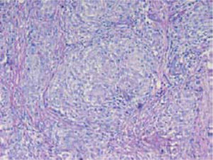 Visión más cercana de uno de los granulomas no caseosos, formado por un denso conglomerado de células epiteliodes acompañadas por células gigantes multinucleadas (tinción de PAS, 160×).