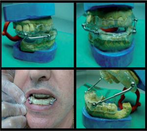 Dispositivo de avance mandibular, antes de su colocación y produciendo el avance de la mandíbula en un paciente.