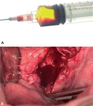 A. Punción-aspiración de la lesión (líquido de color amarillento). B. Imagen intraoral durante la biopsia incisional.