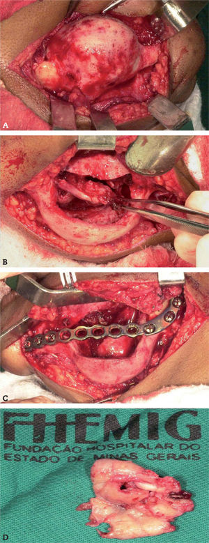 A. La imagen intraoperatoria muestra expansión de las tablas óseas. B. Enucleación de la lesión. C. Placa de reconstrucción mandibular de 2,7 mm de titanio sin injerto óseo en el área afectada. D. Espécimen quirúrgico.