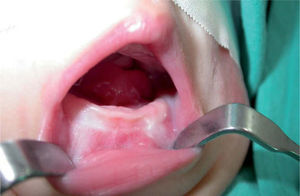 - Clínica intraoral preoperatoria del paciente. Tumor a nivel de suelo de boca que rechaza la lengua hacia la orofaringe, con dificultad para la deglución.