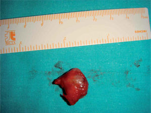 – Espécimen quirúrgico de 2 × 1,5 cm de diámetro.