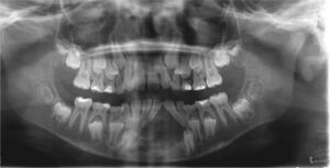 Imagen panorámica de una paciente de 9 años con lesión en la línea media de la mandíbula, unilocular, con desplazamiento de ápices.