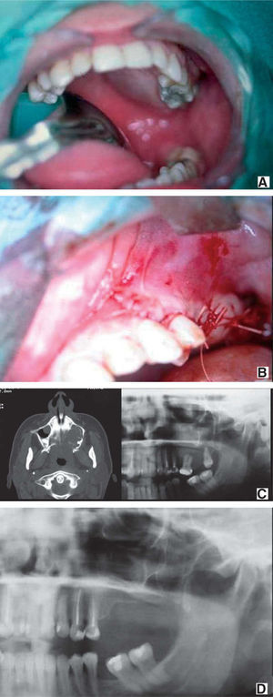A) Detalle de la exploración clínica con expansión de la región palatina izquierda. B) Imagen postoperatoria al mes de la intervención. C) Imagen panorámica preoperatoria y TC de la lesión que afecta el seno maxilar. D) Imagen panorámica postoperatoria a los 6 meses.