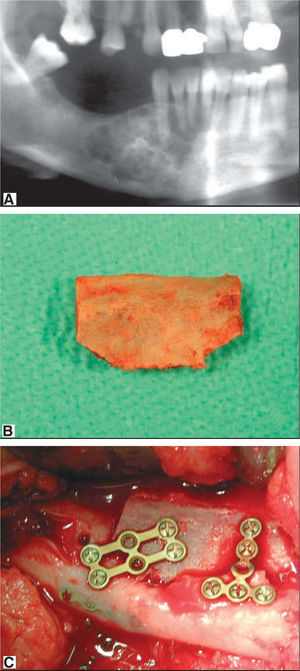 A) Imagen panorámica de lesión en la mandíbula multilocular de bordes mal definidos. B) Detalle del injerto libre de cresta ilíaca. C) Detalle de fijación del injerto con miniplacas.