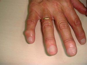 Detalle de la afectación del dedo meñique de la mano derecha.