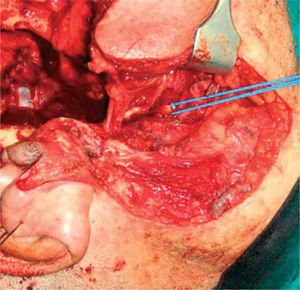 Vessel-loop con control de la arteria carótida interna a nivel cervical.
