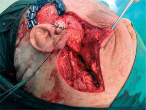 Obliteración de la base craneal lateral con colgajo anterolateral. Se aprecia tutor cutáneo preauricular.