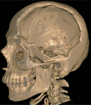 Tomografía computarizada (TC) lateral del paciente.