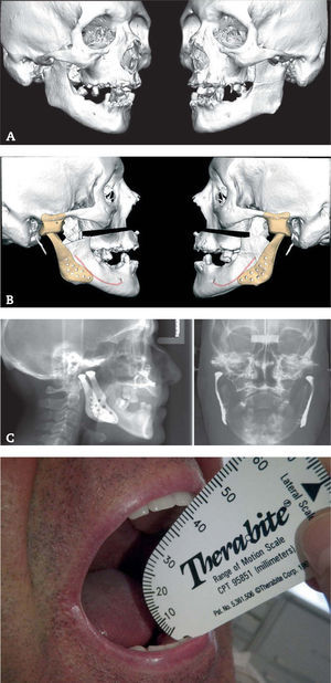 Caso 3 (A-B) Anquilosis articular en paciente con fractura bicondílea de larga evolución. Planificación quirúrgica virtual con prótesis aloplásticas a medida tipo Biomet y osteotomía de LeFort I. (C) Radiología postoperatoria. (D) Máxima apertura oral interincisal de 42mm a los 6 meses de seguimiento.