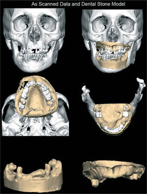 Integración de los modelos de impresión dental en la reconstrucción tridimensional del esqueleto maxilofacial.