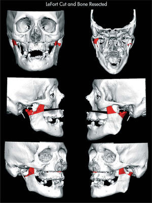 Planificación quirúrgica con áreas a resecar y movimientos maxilomandibulares planificados.