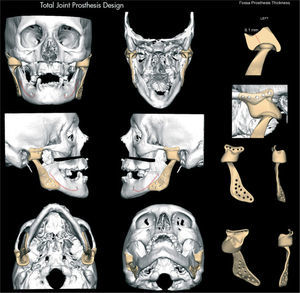 Diseño virtual de prótesis totales custom-made. Componente mandibular y fosa glenoida adaptados a la anatomía del paciente y a los requisitos del diseño.