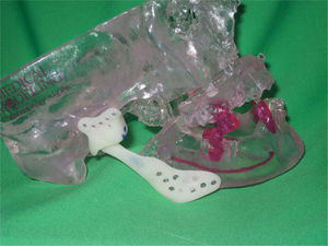 Modelo estereolitográfico con prótesis a medida y movimiento maxilomandibular.