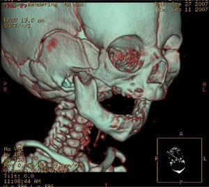 Tomografía computarizada tridimensional. Hipoplasia mandibular grave.