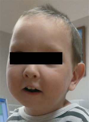 Niño de la figura 3 a los 18 meses posdistracción.
