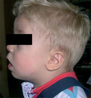 Niño de la figura 4 a los 18 meses posdistracción.