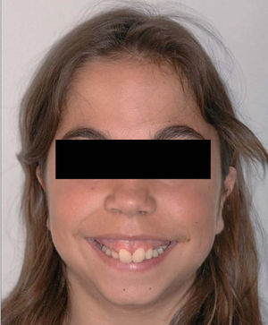 Visión frontal de la paciente, en la que se aprecia una marcada hipoplasia del tercio inferior facial con sonrisa gingival por crecimiento desproporcionado del maxilar superior.