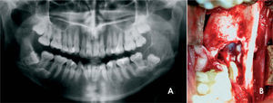 A) Control radiográfico a los 6 meses con cánula de descompresión. B) Cirugía de enucleación de la lesión y exodoncia del tercer molar.